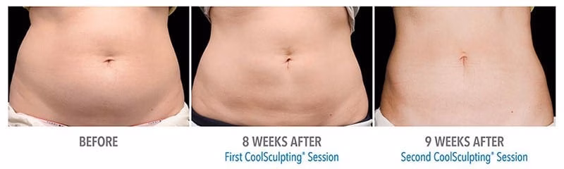 coolsculpting melbourne