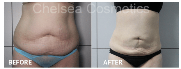 If I Undergo Liposuction, Will the Fat Reappear 3 Liposuction Melbourne before and after 1, blog article