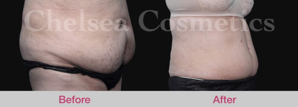 Mega Liposuction – Things You Must Know Before Having Mega Liposuction 2 mega liposuction before and after