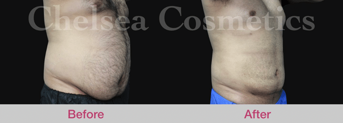 Mega Liposuction – Things You Must Know Before Having Mega Liposuction 3 mega liposuction procedure before and after