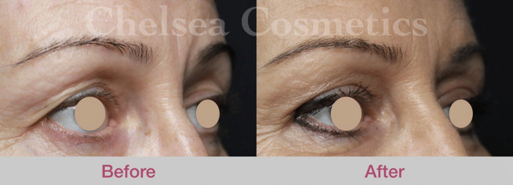 anti-wrinkle injections melbourne before and after
