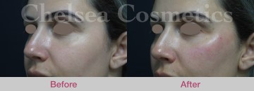 Cheek Fillers Before & After Photos - 1