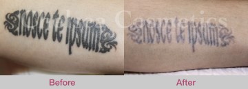Laser Tattoo Removal Before & After Photos - 1