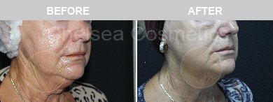 Thread Lift Before & After Photos - 17