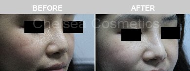 Non-Surgical Rhinoplasty Before & After Photos - 9