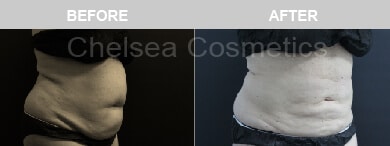 Slim Lipo (women) Before & After Photos - 9