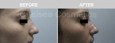 Non-Surgical Rhinoplasty Before & After Photos - 20