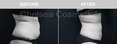 Slim Lipo (women) Before & After Photos - 37