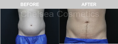 Slim Lipo (men) Before & After Photos - 20
