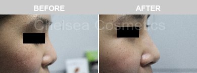 Non-Surgical Rhinoplasty Before & After Photos - 21