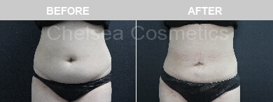 Slim Lipo (women) Before & After Photos - 38