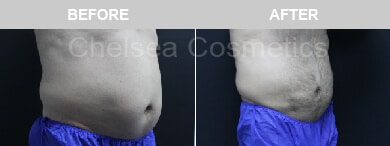 Slim Lipo (men) Before & After Photos - 19