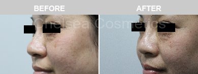 Non-Surgical Rhinoplasty Before & After Photos - 22