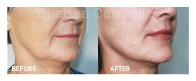 Thread Lift Before & After Photos - 1