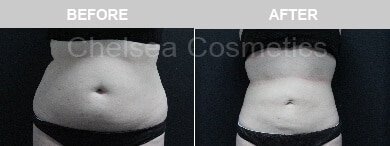 Slim Lipo (women) Before & After Photos - 31