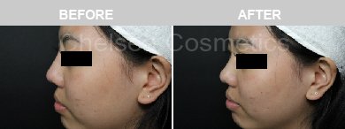 Non-Surgical Rhinoplasty Before & After Photos - 23