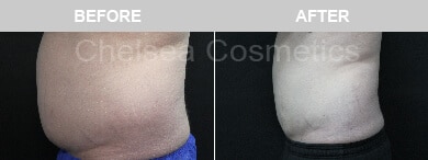 Slim Lipo (men) Before & After Photos - 5