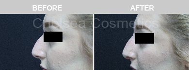 Non-Surgical Rhinoplasty Before & After Photos - 24