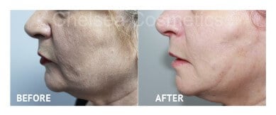 Thread Lift Before & After Photos - 4