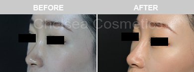 Non-Surgical Rhinoplasty Before & After Photos - 25