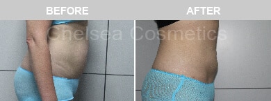 Slim Lipo (women) Before & After Photos - 33