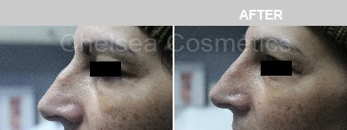 Non-Surgical Rhinoplasty Before & After Photos - 12