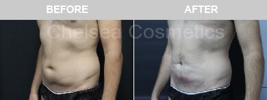 Slim Lipo (men) Before & After Photos - 7