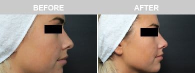 Non-Surgical Rhinoplasty Before & After Photos - 26
