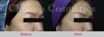 Thread Lift Before & After Photos - 11