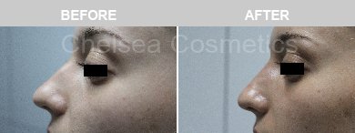 Non-Surgical Rhinoplasty Before & After Photos - 19