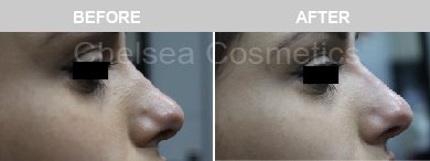 Non-Surgical Rhinoplasty Before & After Photos - 1