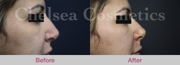 Thread Lift Before & After Photos - 15