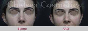 Cheek Fillers Before & After Photos - 2