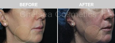 Thread Lift Before & After Photos - 18