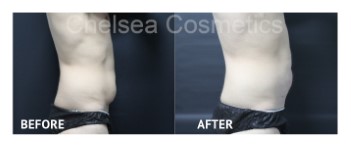Slim Lipo (men) Before & After Photos - 3