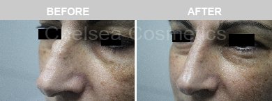 Non-Surgical Rhinoplasty Before & After Photos - 11