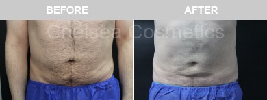 Slim Lipo (men) Before & After Photos - 17