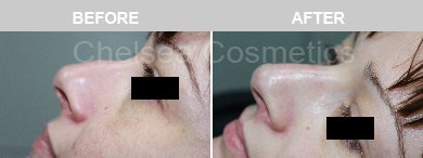Non-Surgical Rhinoplasty Before & After Photos - 2
