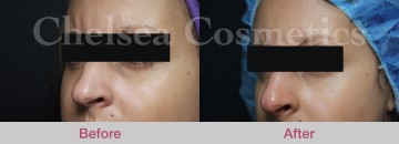 Thread Lift Before & After Photos - 12