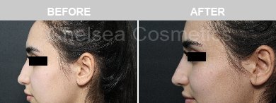 Non-Surgical Rhinoplasty Before & After Photos - 3