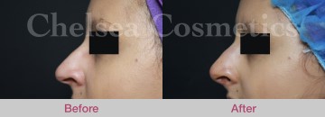 Thread Lift Before & After Photos - 13