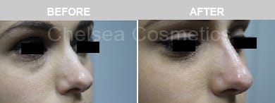 Non-Surgical Rhinoplasty Before & After Photos - 4