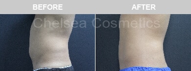 Slim Lipo (men) Before & After Photos - 9