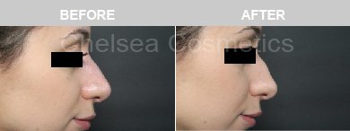 Non-Surgical Rhinoplasty Before & After Photos - 5
