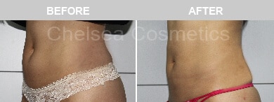 Slim Lipo (women) Before & After Photos - 7