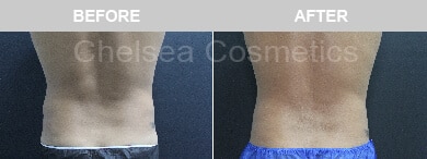 Slim Lipo (men) Before & After Photos - 8