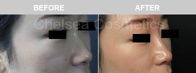 Non-Surgical Rhinoplasty Before & After Photos - 6
