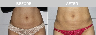 Slim Lipo (women) Before & After Photos - 8