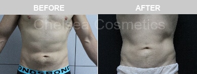 Slim Lipo (men) Before & After Photos - 16