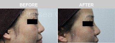 Non-Surgical Rhinoplasty Before & After Photos - 7
